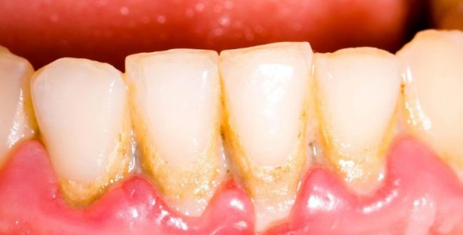 جرم گیری دندان با استفاده از چ