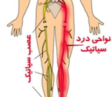 درمان درد عصب سیاتیک

  برا